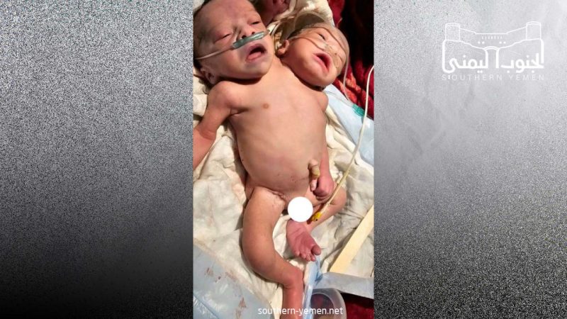 في حالة نادرة .. ولادة توأم ملتصق في أحد مستشفيات ذمار
