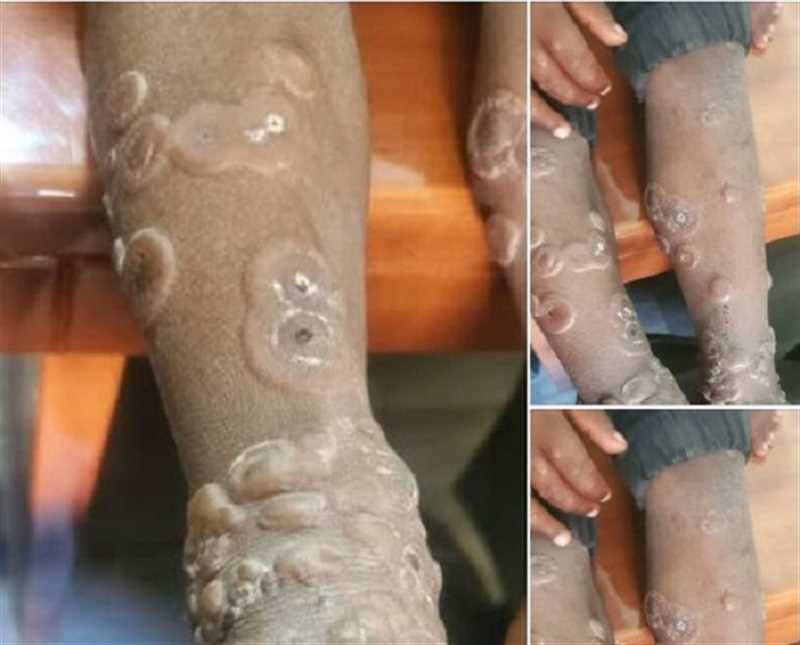 مركز طبي يُبلغ عن حالة مشتبه إصابتها بجدري القرود في إب