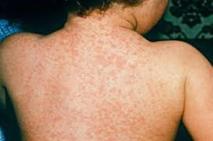 تفشي الحصبة في تعز.. وفاة طفلين وارتفاع حالات الاشتباه إلى 382 .