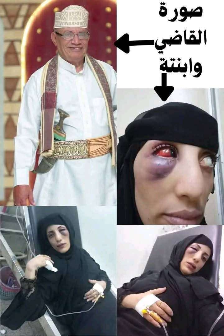 تعز: اعتداء مجهول على ابنة قاضٍ يثير استياءً واسعًا.