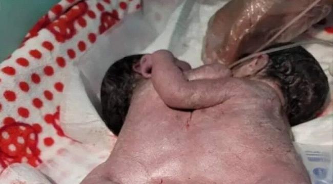 في حالة نادرة عالميًا.. نجاح ولادة قيصرية لتوأم ملتصق بقلب واحد في ذمار
