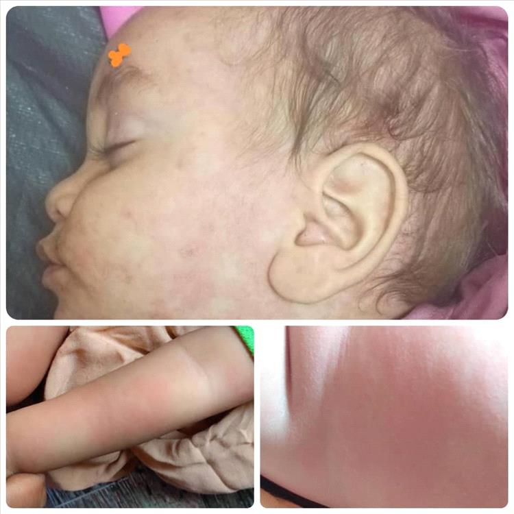 لحج: تزايد حالات الحصبة في ريف مديرية المسيمير والأهالي يناشدون التدخل